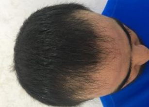 dr-kul-3100-grafts
