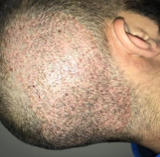 dr-kul-3100-grafts