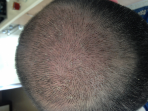 Dr.Muttalip Keser 1800 greft vertex