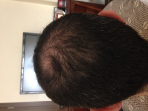 Dr.Muttalip Keser 1800 greft vertex