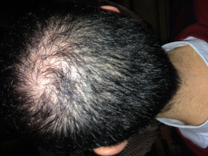 Dr.Muttalip Keser 1800 greft vertex