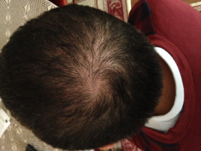 Dr.Muttalip Keser 1800 greft vertex