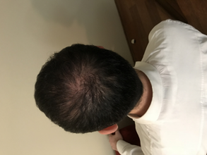Dr.Muttalip Keser 1800 greft vertex
