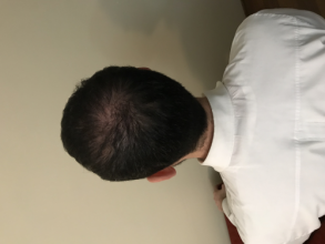 Dr.Muttalip Keser 1800 greft vertex