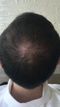 Dr.Muttalip Keser 1800 greft vertex