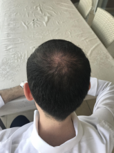Dr.Muttalip Keser 1800 greft vertex