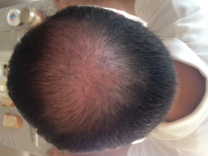 Dr.Muttalip Keser 1800 greft vertex
