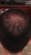Dr.Muttalip Keser 1800 greft vertex