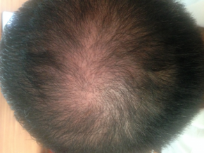 Dr.Muttalip Keser 1800 greft vertex