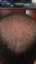 Dr.Muttalip Keser 1800 greft vertex