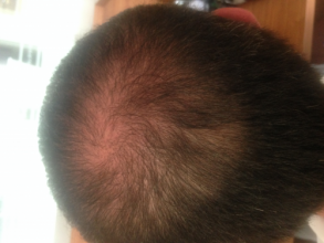 Dr.Muttalip Keser 1800 greft vertex