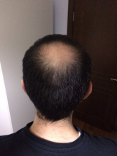 Dr.Muttalip Keser 1800 greft vertex
