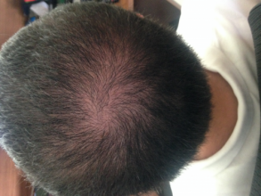 Dr.Muttalip Keser 1800 greft vertex