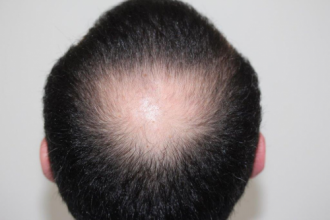Dr.Muttalip Keser 1800 greft vertex
