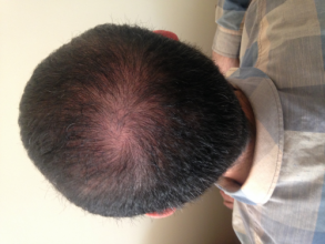 Dr.Muttalip Keser 1800 greft vertex