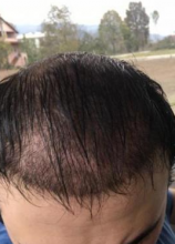 aisha-hair-transplant-4500-grafts