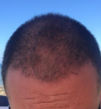 asmed-5034-grafts