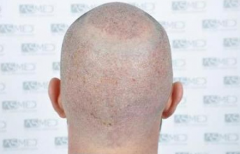 asmed-5034-grafts