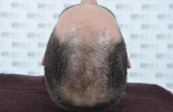 asmed-5034-grafts