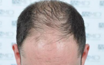 asmed-5034-grafts
