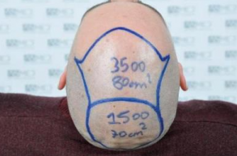asmed-5034-grafts