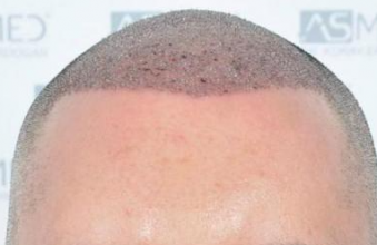 asmed-5034-grafts
