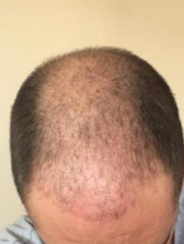 asmed-5034-grafts