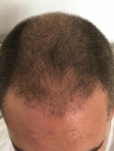 asmed-5034-grafts