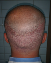 beard+hair-transplant