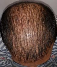 beard+hair-transplant