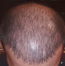 beard+hair-transplant