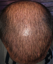 beard+hair-transplant