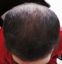 beard+hair-transplant