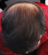 beard+hair-transplant