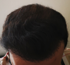 beard+hair-transplant