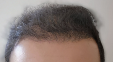 beard+hair-transplant