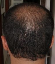 beard+hair-transplant