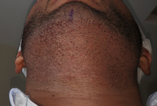 beard+hair-transplant