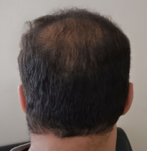 beard+hair-transplant