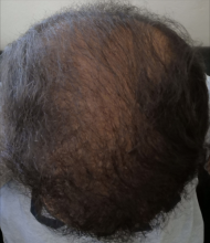 beard+hair-transplant