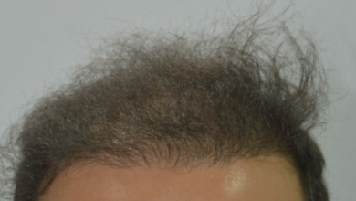 beard+hair-transplant