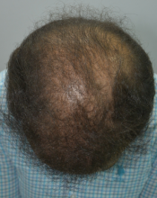 beard+hair-transplant