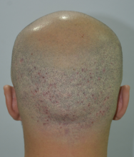 beard+hair-transplant