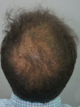 beard+hair-transplant
