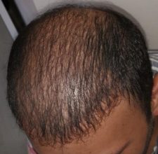 beard+hair-transplant