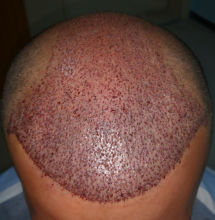 beard+hair-transplant