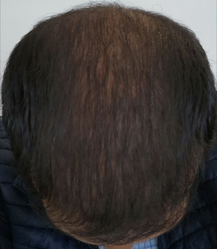 beard+hair-transplant