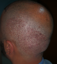 beard+hair-transplant