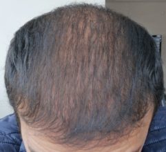 beard+hair-transplant