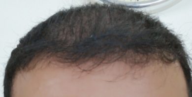 beard+hair-transplant